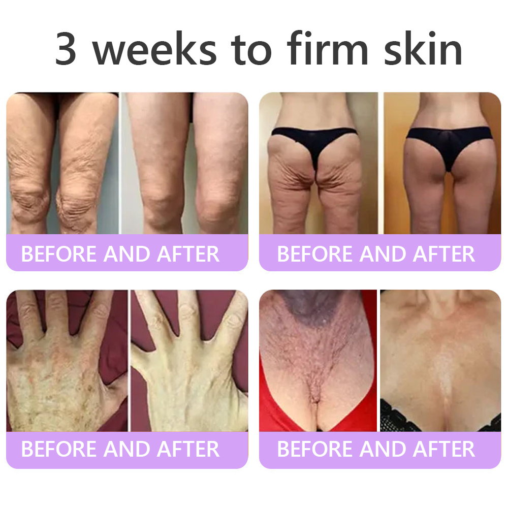 Vitalisys®❤️PDRN Multi-Peptide Massaging Body Roller Cream- Anti-aging, Hydrating, Skin Firming & Lifting, Skin Repair, Even Tone, Acne and Dark Spot Treatment, Wart and Mole Removal, and Psoriasis Relief.
