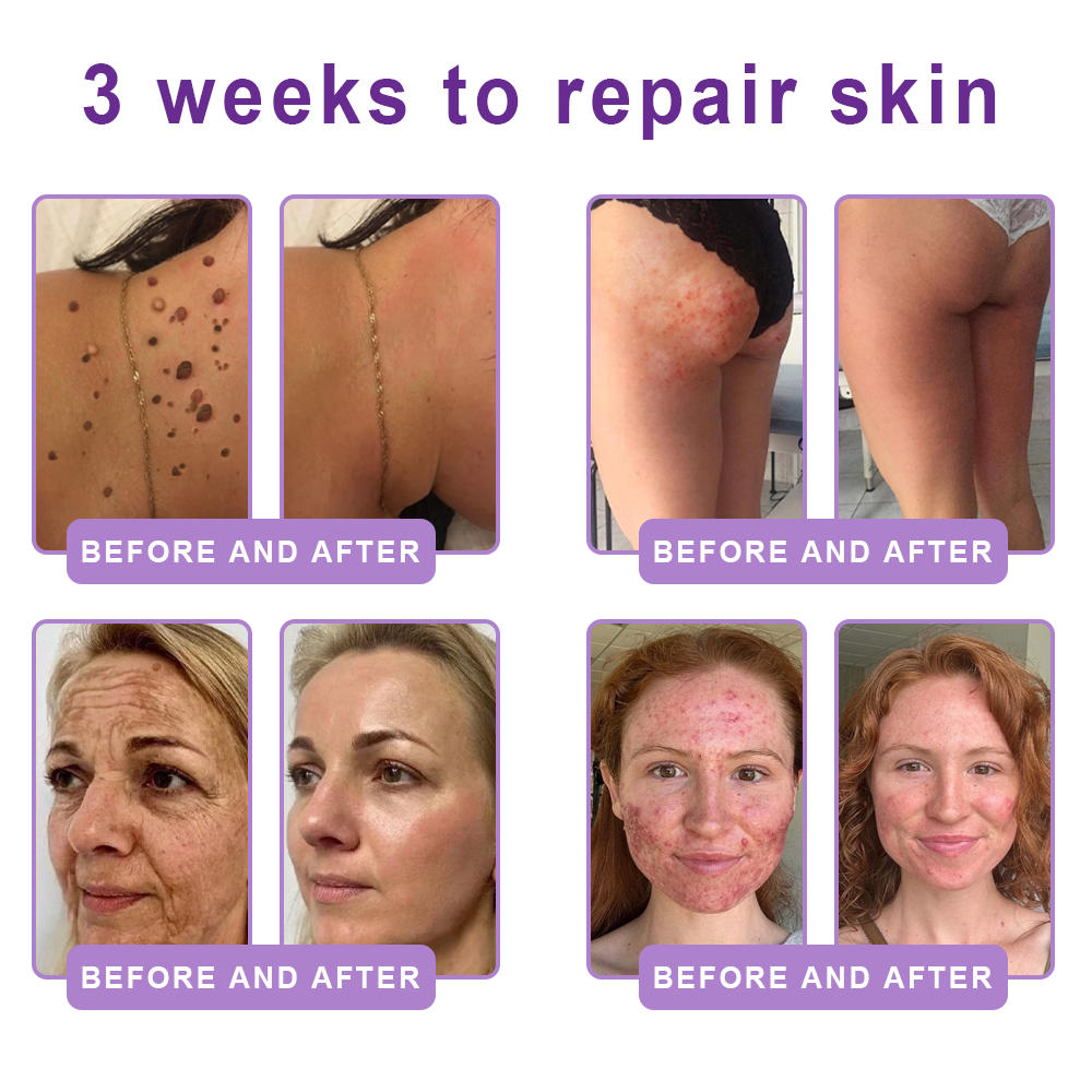 Vitalisys®❤️PDRN Multi-Peptide Massaging Body Roller Cream- Anti-aging, Hydrating, Skin Firming & Lifting, Skin Repair, Even Tone, Acne and Dark Spot Treatment, Wart and Mole Removal, and Psoriasis Relief.
