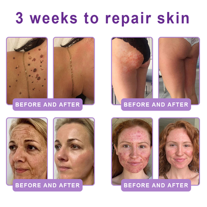 Vitalisys®❤️PDRN Multi-Peptide Massaging Body Roller Cream- Anti-aging, Hydrating, Skin Firming & Lifting, Skin Repair, Even Tone, Acne and Dark Spot Treatment, Wart and Mole Removal, and Psoriasis Relief.
