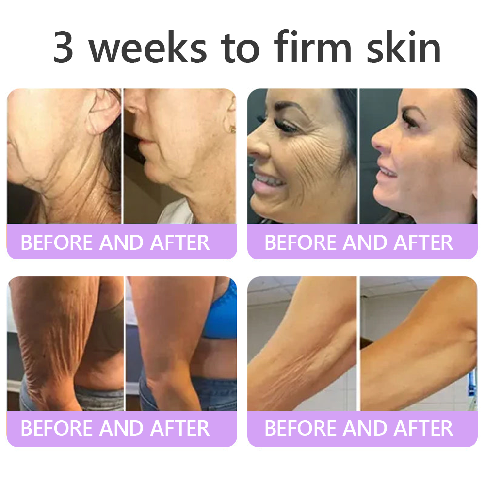 Vitalisys®❤️PDRN Multi-Peptide Massaging Body Roller Cream- Anti-aging, Hydrating, Skin Firming & Lifting, Skin Repair, Even Tone, Acne and Dark Spot Treatment, Wart and Mole Removal, and Psoriasis Relief.