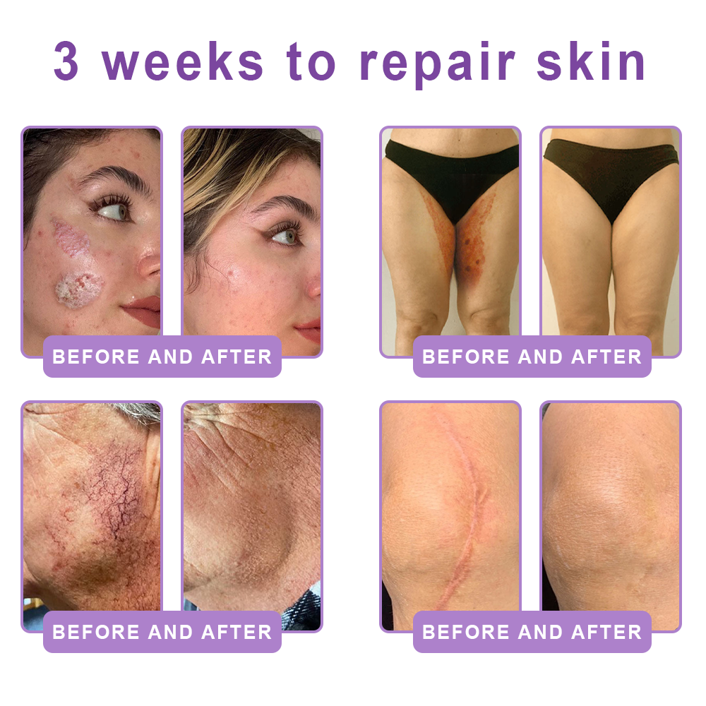 Vitalisys®❤️PDRN Multi-Peptide Massaging Body Roller Cream- Anti-aging, Hydrating, Skin Firming & Lifting, Skin Repair, Even Tone, Acne and Dark Spot Treatment, Wart and Mole Removal, and Psoriasis Relief.