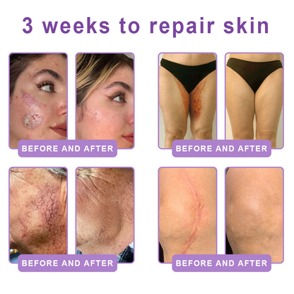 Vitalisys®❤️PDRN Multi-Peptide Massaging Body Roller Cream- Anti-aging, Hydrating, Skin Firming & Lifting, Skin Repair, Even Tone, Acne and Dark Spot Treatment, Wart and Mole Removal, and Psoriasis Relief.